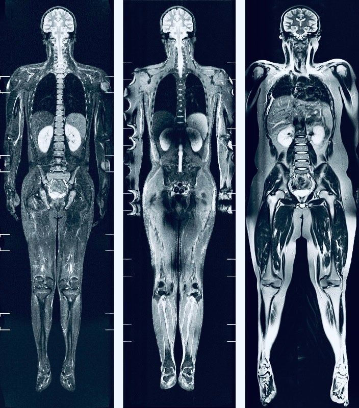 Should you get a full-body scan to look for cancer?